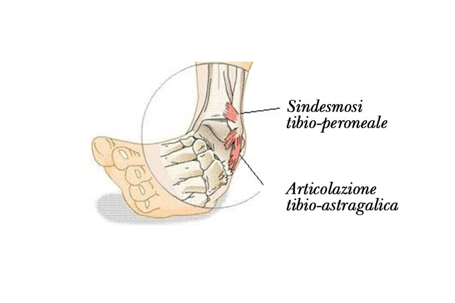 sindesmosi caviglia - Dottor Attilio Basile