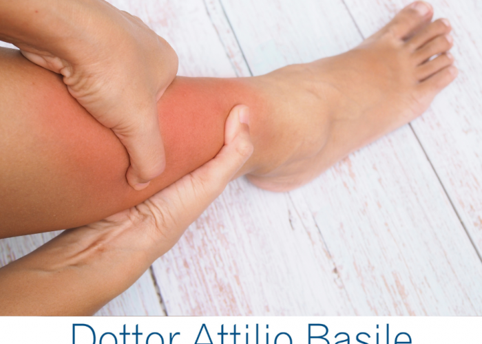 Lussazione caviglia, sintomi, cause e rimedi - Dr. Attilio Basile