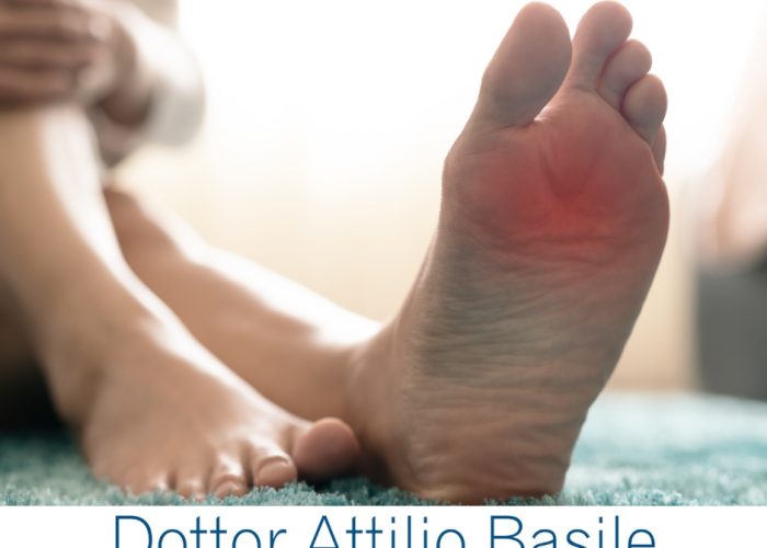 Metatarsalgia Piede cause, sintomi e trattamento, Dr. Attilio Basile
