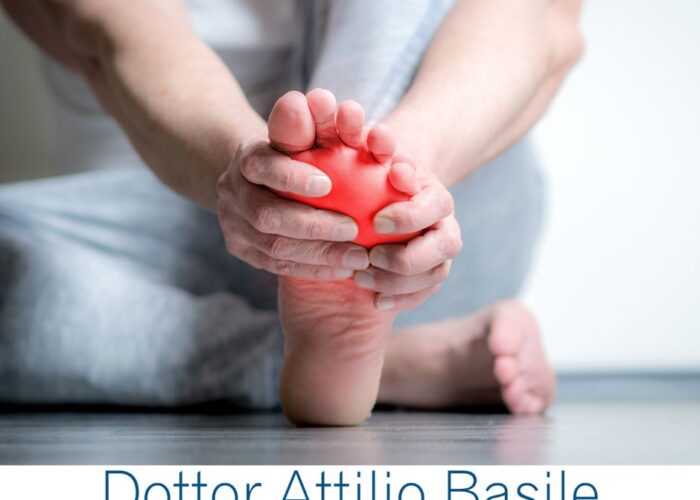 Neuroma di Morton, che cos'è Dottor Attilio Basile