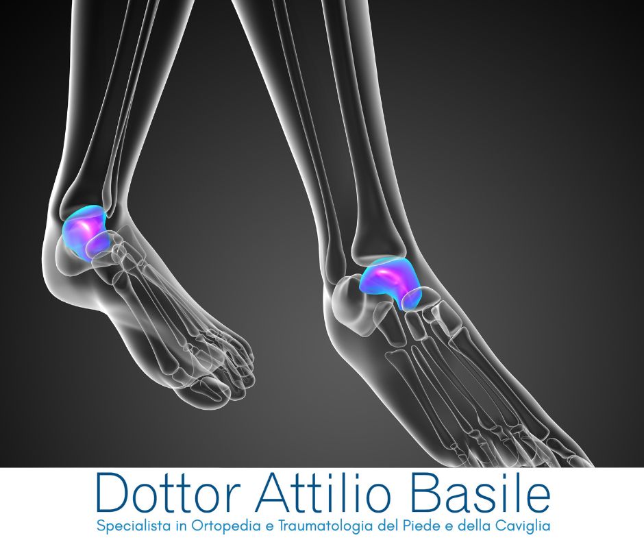 Frattura del malleolo guarigione, carico e riabilitazione