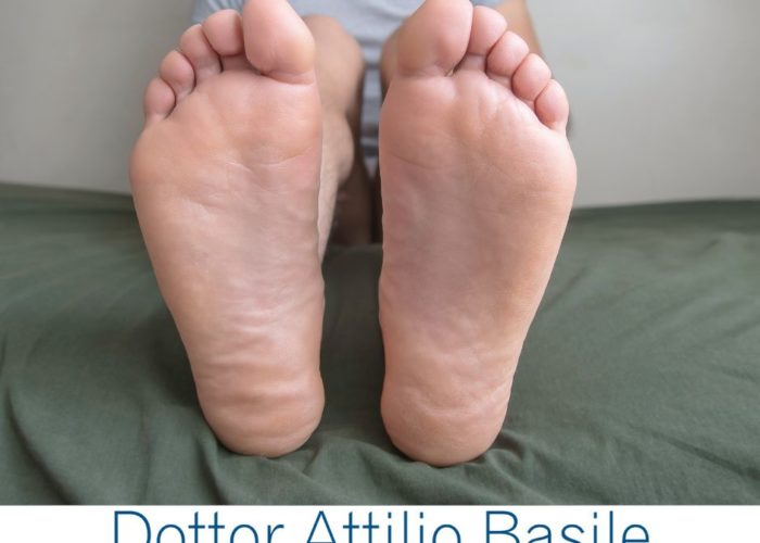 Dita a martello quando le dita del piede si piegano e fanno male nelle scarpe Dottor Attilio Basile