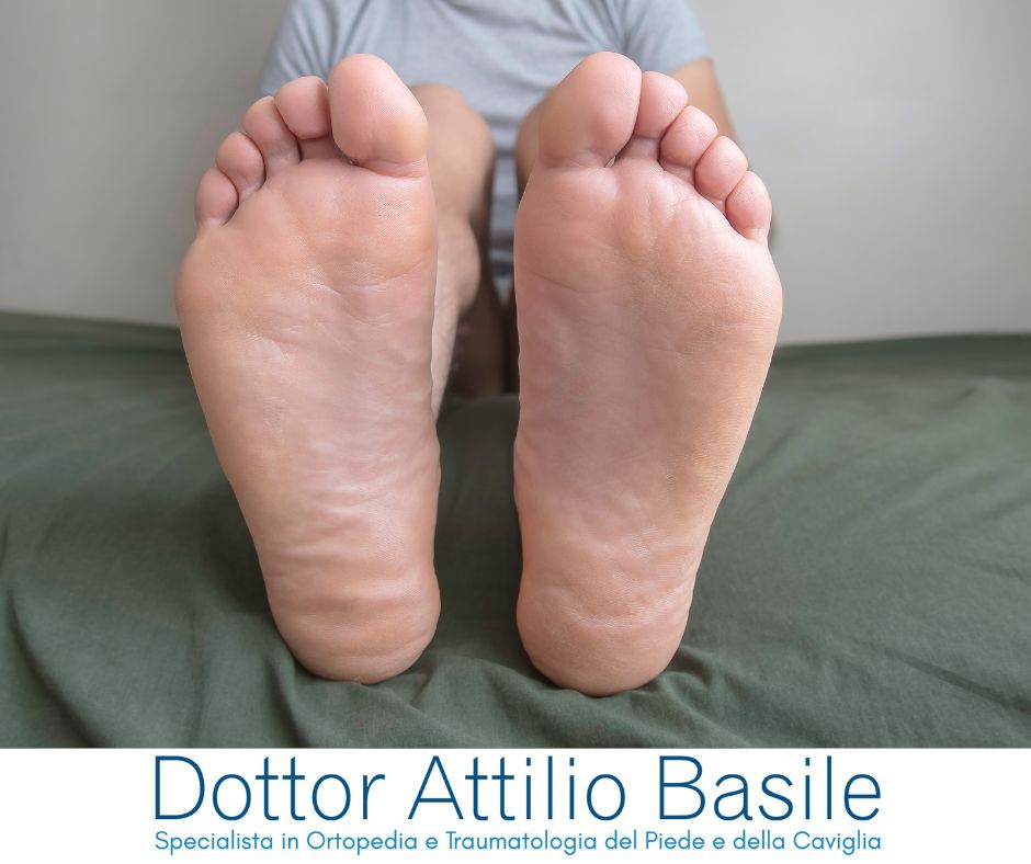 Dita a martello quando le dita del piede si piegano e fanno male nelle scarpe Dottor Attilio Basile