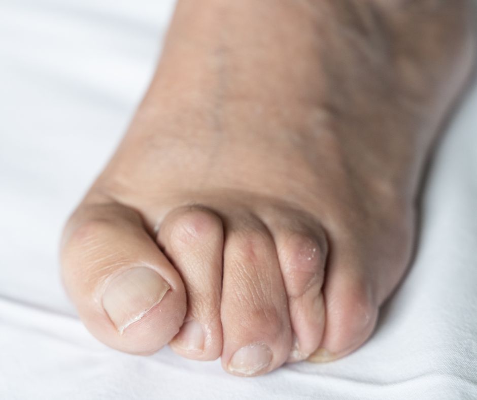 Dr.Basile Dita a martello - specialista piede e caviglia Roma